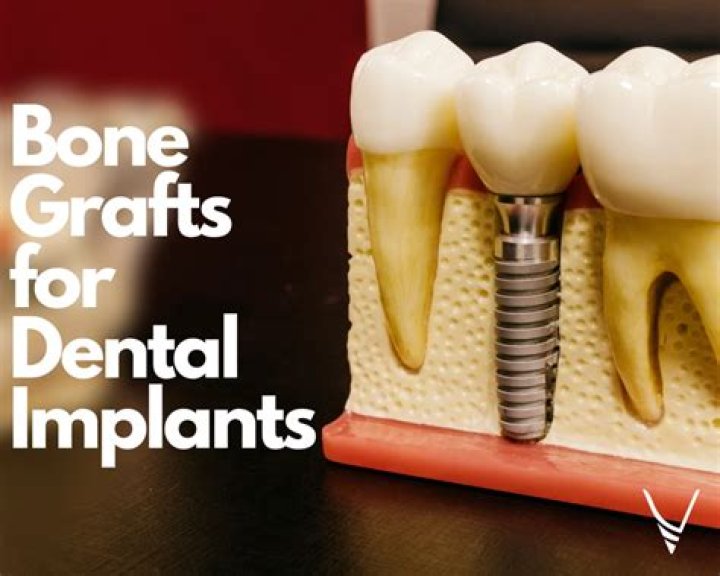 Do dental implants require bone grafts?