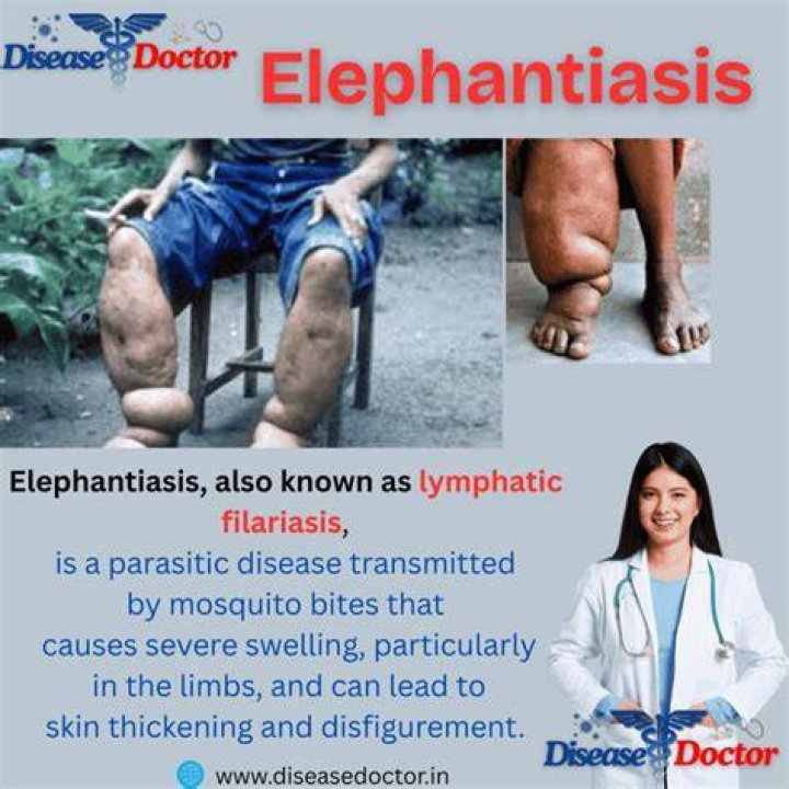 Does elephantiasis affect the legs?