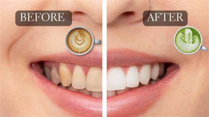 Does tea stain your teeth?