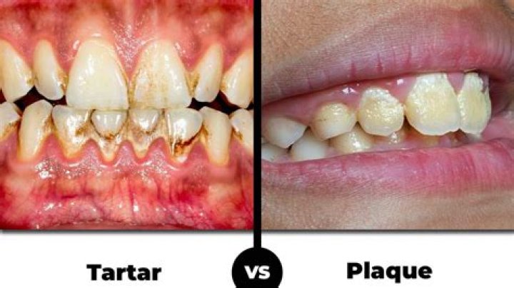 How does plaque look like?