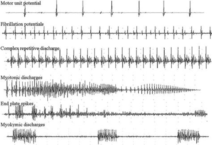Why is emg waveform irregular?
