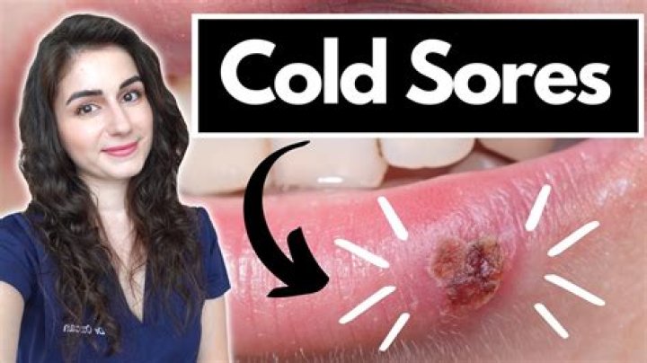 Will ice help a cold sore?