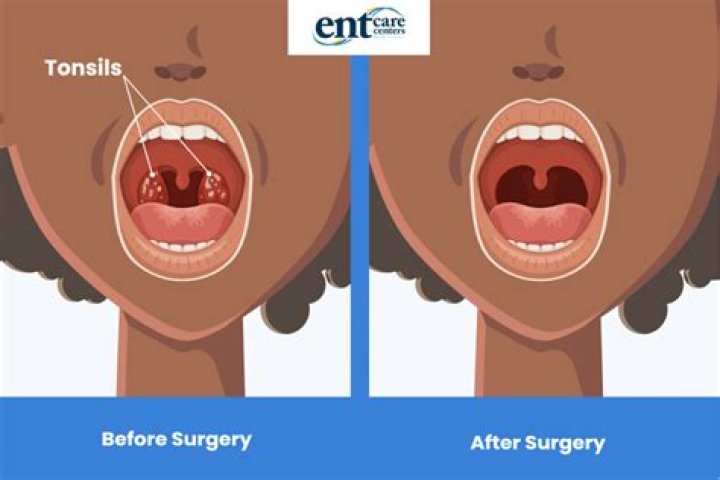Will removing tonsils help with snoring?