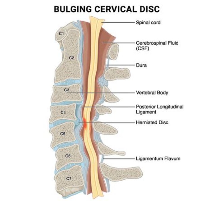 Would a chiropractor help a bulging disc?